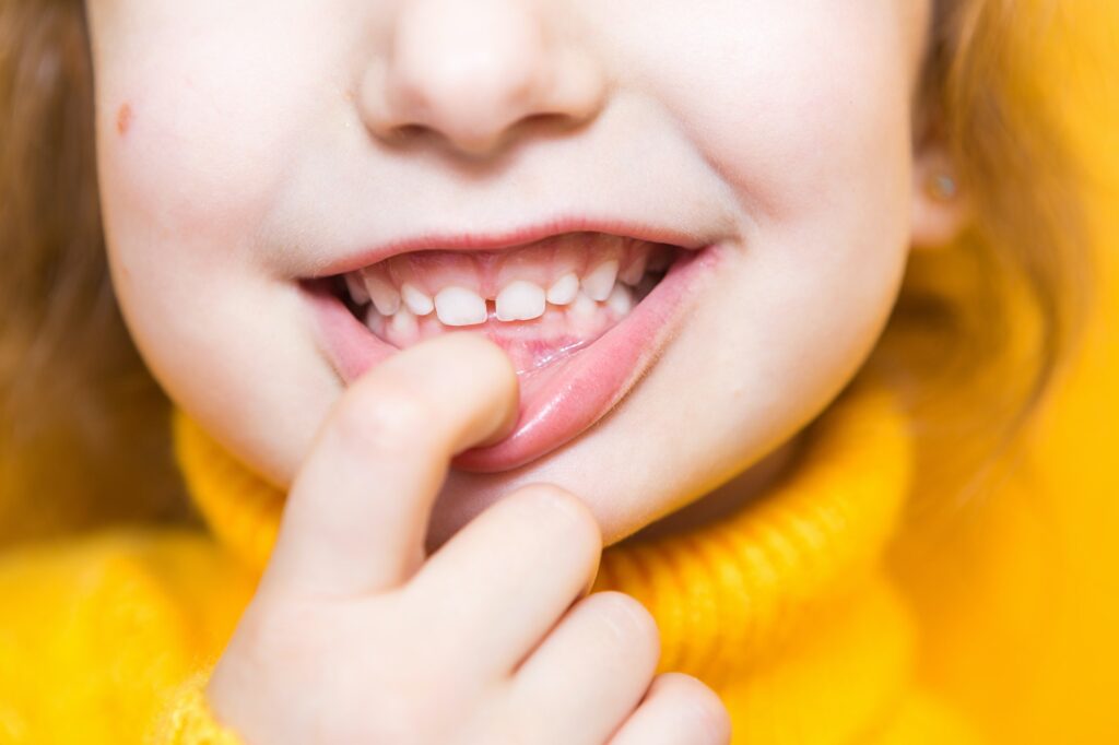 Girl shows her teeth-pathological bite, malocclusion, overbite. Pediatric dentistry