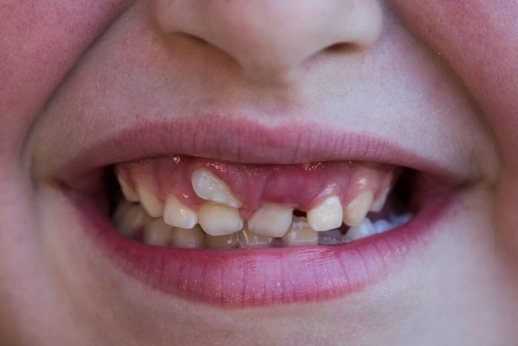 shark teeth in kids st louis